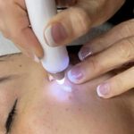 Cryotherapy spot removal